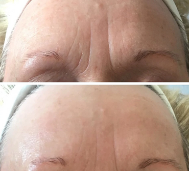 Descubre el enfoque botox-like cosmético de Skin Boosters de Juliette Armand.
